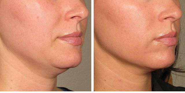 skin tightening Salisbury