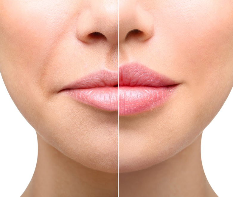 Dermal Fillers Salisbury